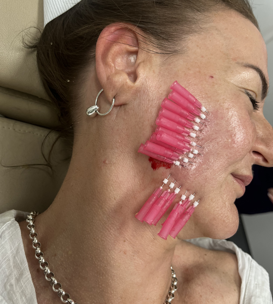 collagen induction therapy content img 1